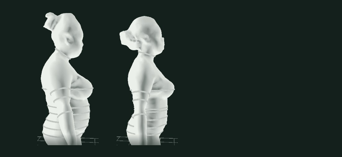 Two 3D body scan profiles of the same patient side by side, showing measured change in abdominal circumference