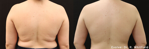 1764956431 fat removal body sculpting 7 1
