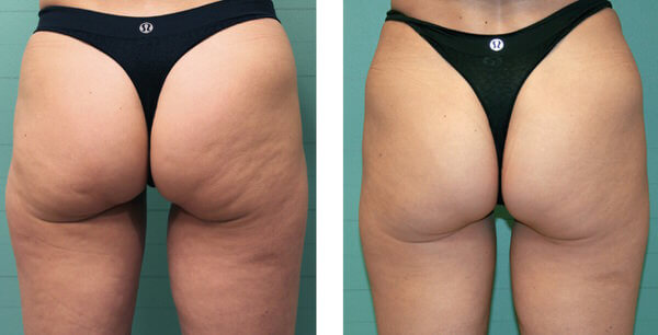 1764956443 fat removal body sculpting 3 1