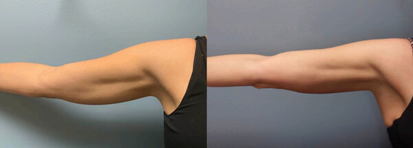 1764956446 fat removal body sculpting 2 1