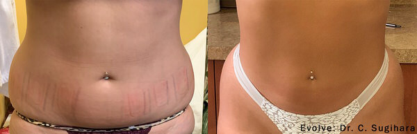 1764956449 fat removal body sculpting 1 1