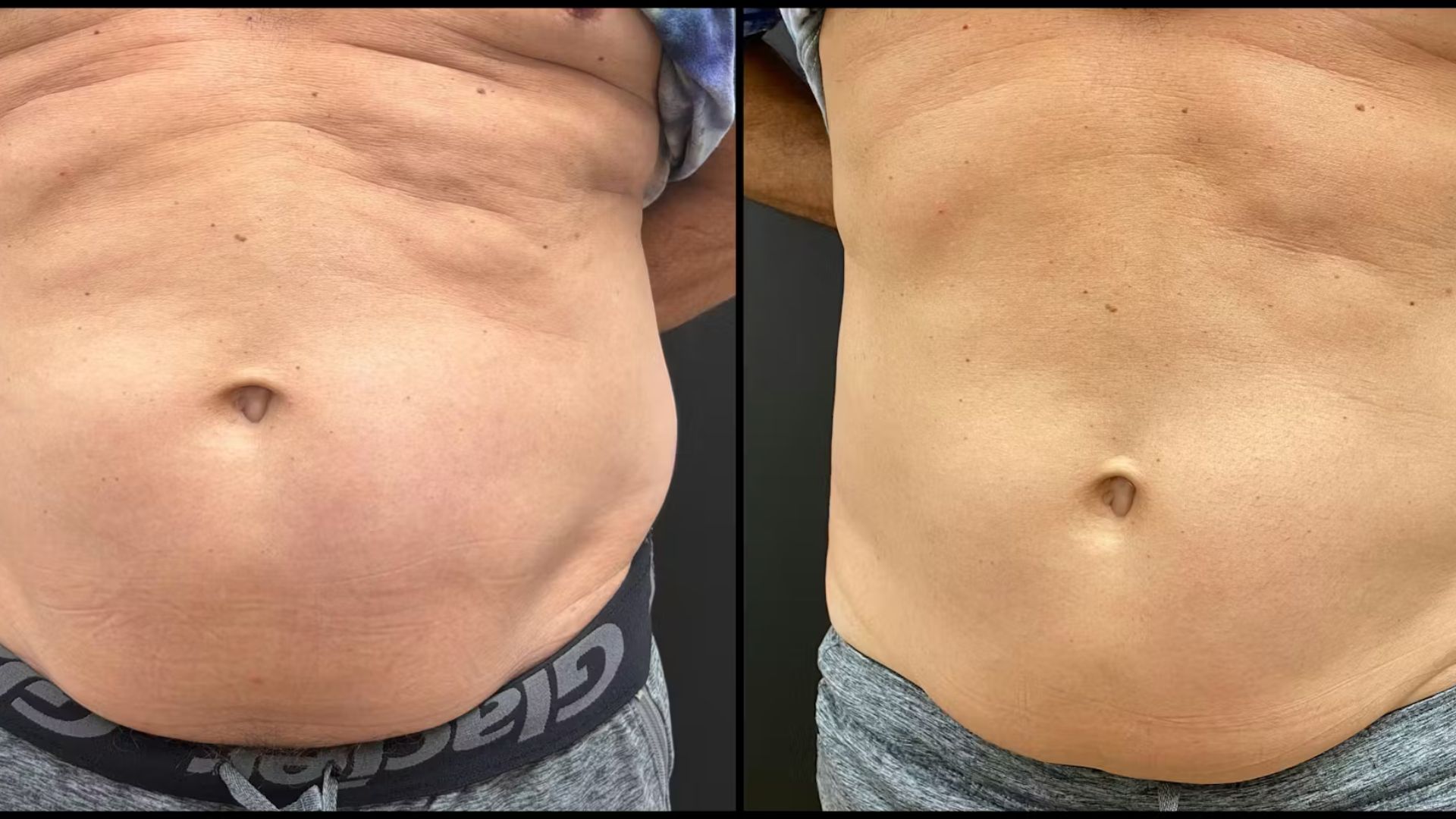 Male patient, oblique view, before and after: abdomen, shirt lifted, wearing grey sweatpants